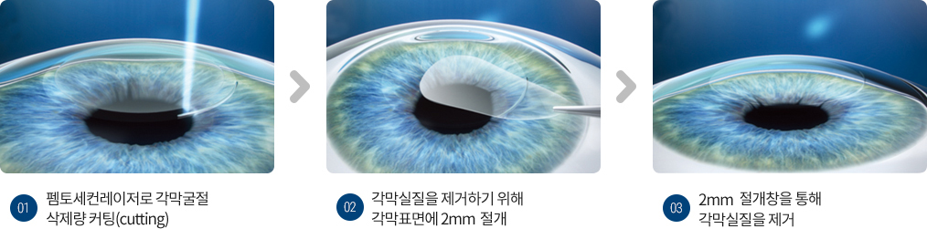 비쥬맥스 스마일(SMILE)라식 수술 과정